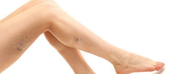 Varis En Çok Kimlerde Görülür?