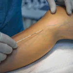 lazerle-varis-tedavisi