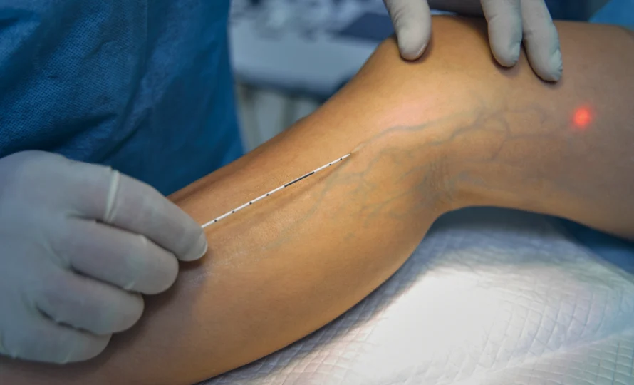 lazerle-varis-tedavisi